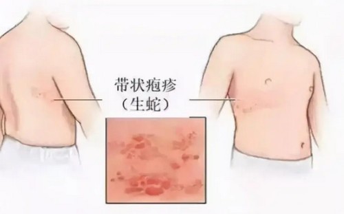 带状疱疹和水痘有什么区别？